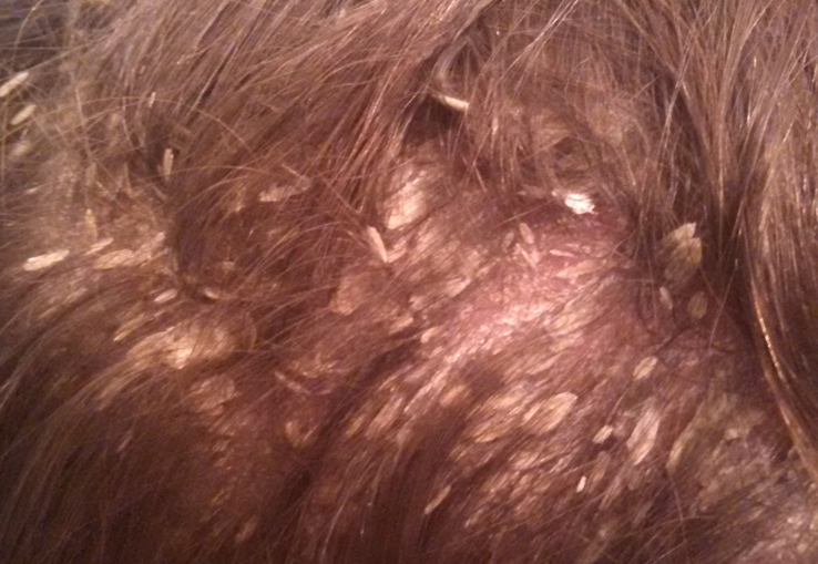 Seborrheic dermatitis, what is it?